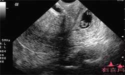 境外代孕:直肠膀胱的子宫内膜异位症者的检查诊